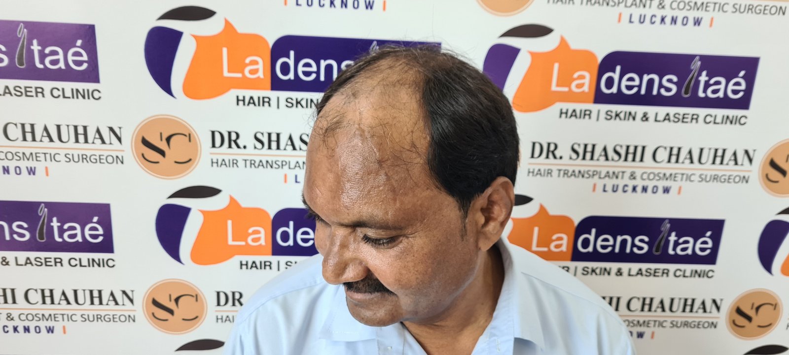AK Singh Before Hair Transplant